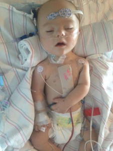 open-heart surgery, down syndrome, pictures