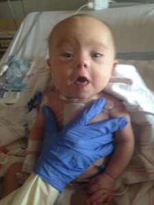 Open Heart Surgery, Day 1, down syndrome, pictures